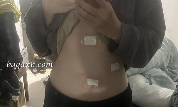 生活│腹腔鏡膽囊切除手術,成為無膽之人的生活分享//中山醫住院手術分享 - 第5張圖 生活│腹腔鏡膽囊切除手術,成為無膽之人的生活分享//中山醫住院手術分享