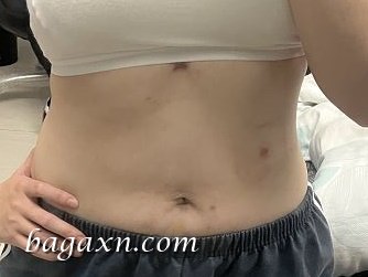 生活│腹腔鏡膽囊切除手術,成為無膽之人的生活分享//中山醫住院手術分享 - 第6張圖 生活│腹腔鏡膽囊切除手術,成為無膽之人的生活分享//中山醫住院手術分享