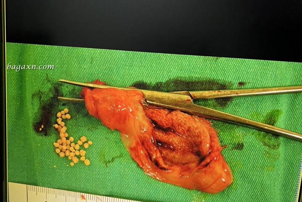 生活│腹腔鏡膽囊切除手術,成為無膽之人的生活分享//中山醫住院手術分享 - 第7張圖 生活│腹腔鏡膽囊切除手術,成為無膽之人的生活分享//中山醫住院手術分享