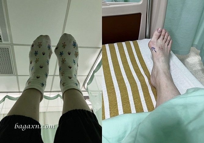 生活│拇指外翻手術心得#1-台北長庚門診及林口長庚住院分享 - 第16張圖 生活│拇指外翻手術心得#1-台北長庚門診及林口長庚住院分享