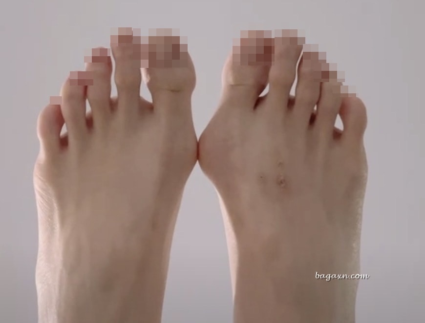 生活│拇指外翻手術心得#1-台北長庚門診及林口長庚住院分享 - 第2張圖 生活│拇指外翻手術心得#1-台北長庚門診及林口長庚住院分享