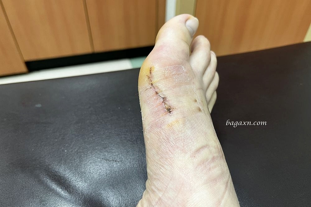 生活│拇指外翻手術心得#2-二週後回診及手術費用分享 - 第10張圖 生活│拇指外翻手術心得#2-二週後回診及手術費用分享