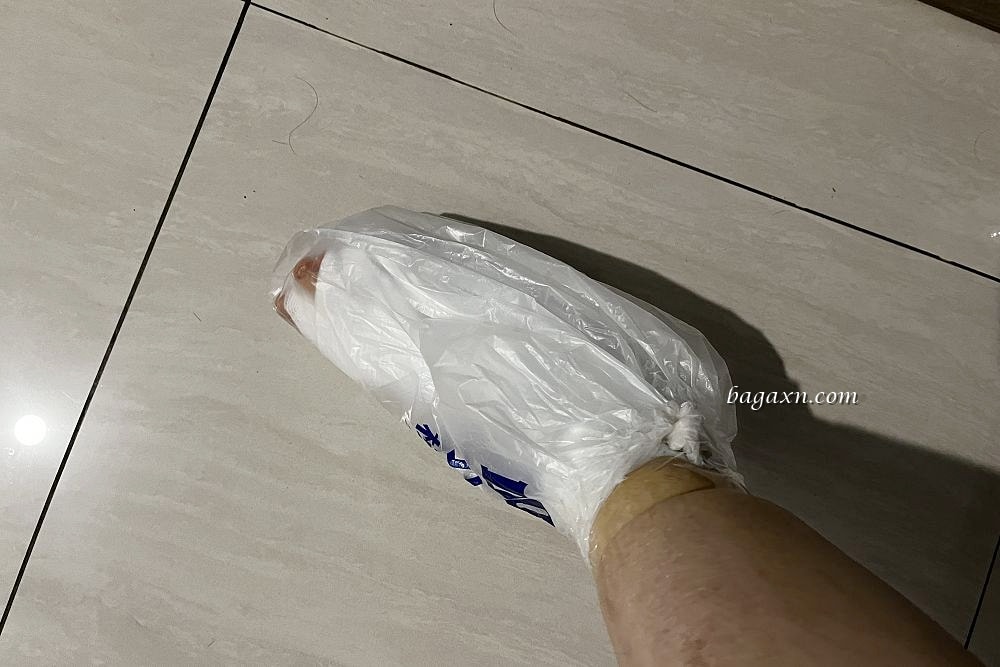 生活│拇指外翻手術心得#2-二週後回診及手術費用分享 - 第2張圖 生活│拇指外翻手術心得#2-二週後回診及手術費用分享