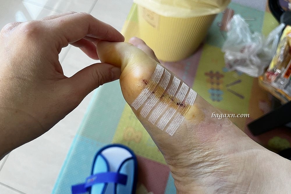 生活│拇指外翻手術心得#2-二週後回診及手術費用分享 - 第4張圖 生活│拇指外翻手術心得#2-二週後回診及手術費用分享