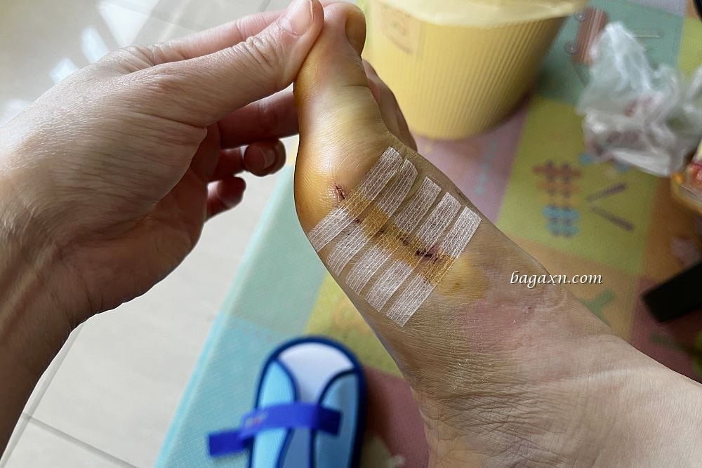 生活│拇指外翻手術心得#2-二週後回診及手術費用分享 - 第5張圖 生活│拇指外翻手術心得#2-二週後回診及手術費用分享