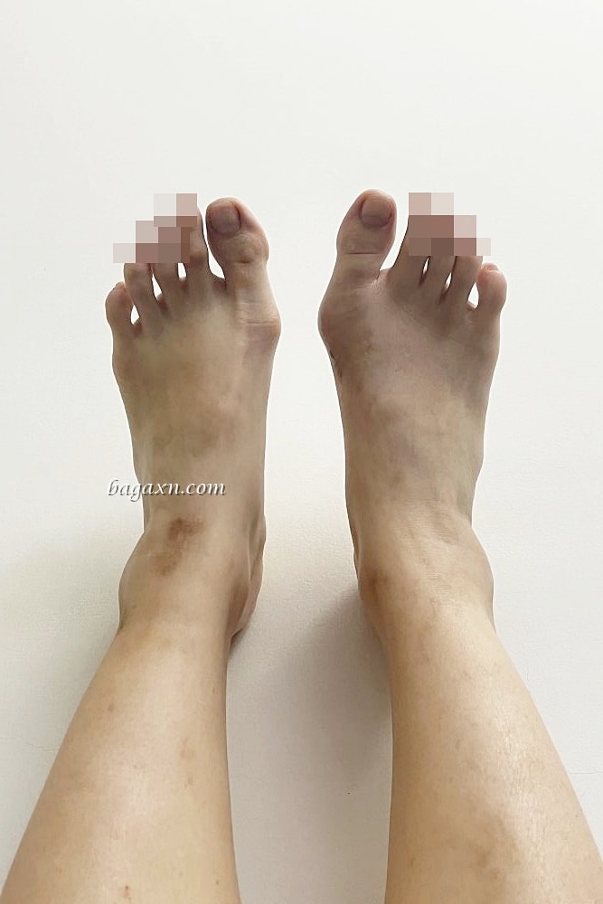 生活│拇指外翻手術心得#3-術後二個月回診及後續分享 - 第2張圖 生活│拇指外翻手術心得#3-術後二個月回診及後續分享