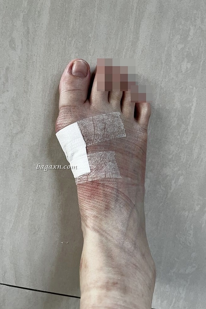 生活│拇指外翻手術心得#3-術後二個月回診及後續分享 - 第4張圖 生活│拇指外翻手術心得#3-術後二個月回診及後續分享