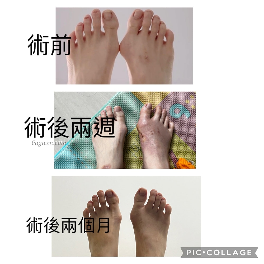 生活│拇指外翻手術心得#3-術後二個月回診及後續分享 - 第5張圖 生活│拇指外翻手術心得#3-術後二個月回診及後續分享