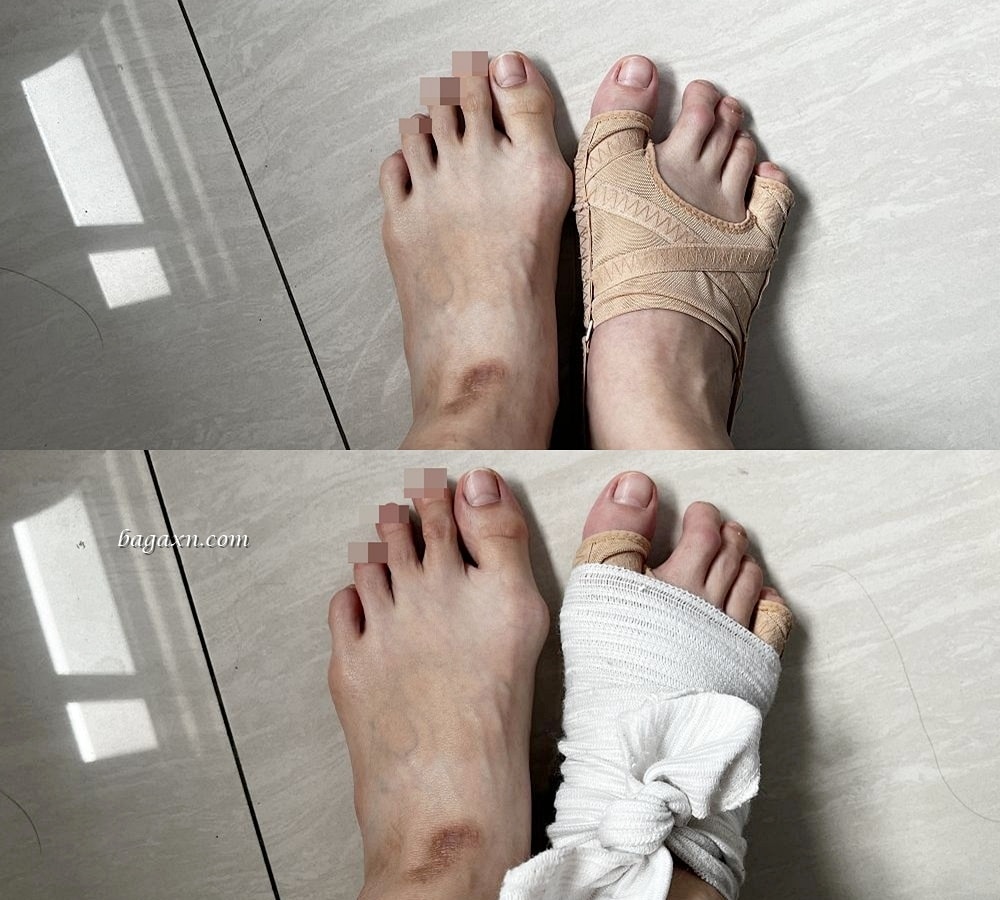 生活│拇指外翻手術心得#3-術後二個月回診及後續分享 - 第7張圖 生活│拇指外翻手術心得#3-術後二個月回診及後續分享