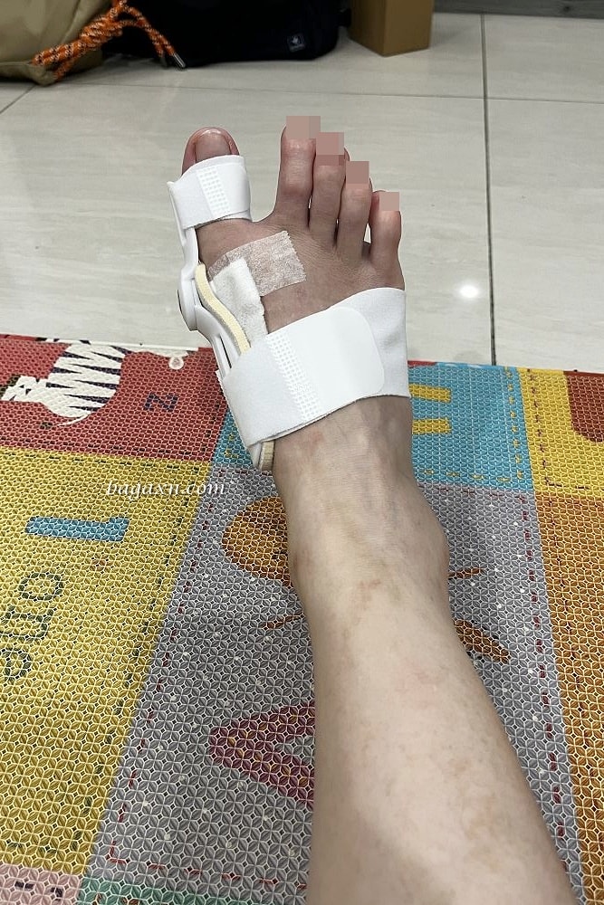 生活│拇指外翻手術心得#3-術後二個月回診及後續分享 - 第8張圖 生活│拇指外翻手術心得#3-術後二個月回診及後續分享